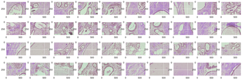 Breast Cancer Detection